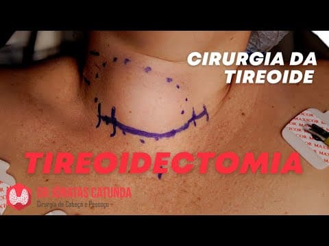 Dicas para quem vai passar pela cirurgia da tireoide - tireoidectomia