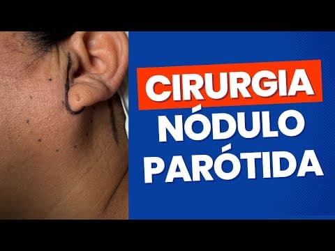 Nódulo na parótida - detalhes da cirurgia de parotidectomia