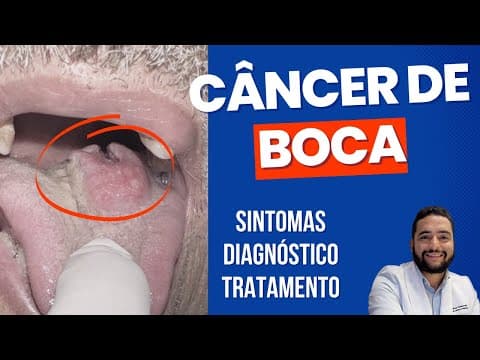 Câncer de boca - Sintomas, diagnóstico e tratamento
