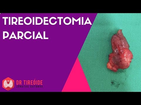 Tireoidectomia parcial