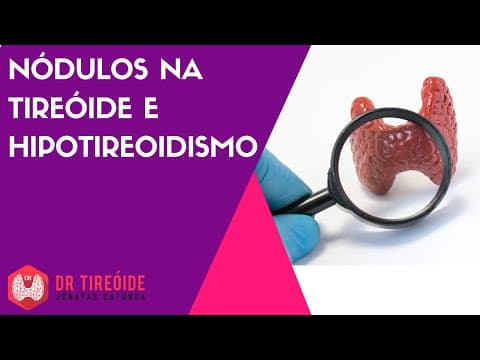Nódulos na tireóide e hipotireoidismo | Dr Jônatas Catunda
