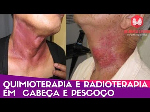 Quimioterapia e radioterapia em cabeça e pescoço